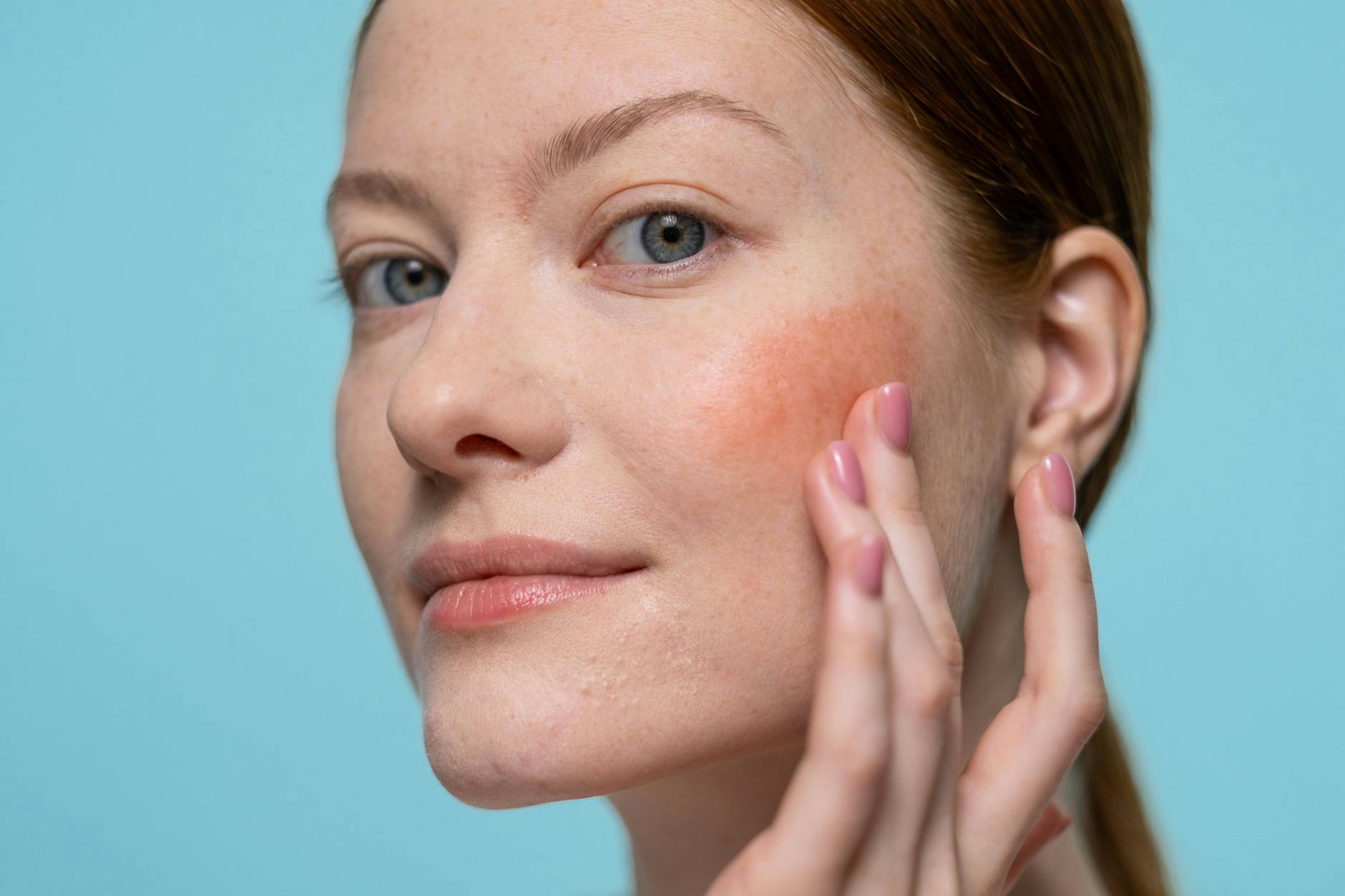 Rosácea em Casa: O Guia Definitivo para Aliviar a Inflamação e Reduzir Vermelhidão — como tratar pele com rosacea em casa | M